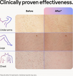 Braun Smart IPL Skin iexpert PL7253 IPL-apparaat Braun Smart IPL Skin iexpert PL7253 IPL-apparaat